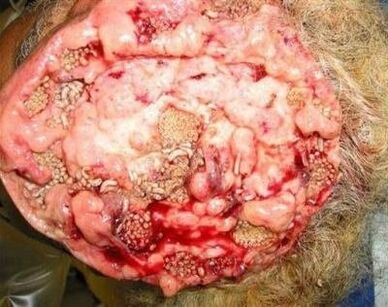 parassiti nel cervello umano